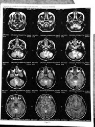 Is Synthetic Oil Better >> Alysa Erwin Cannabis Oil Remission from Malignant ... Is Synthetic Oil Better >> Alysa Erwin Cannabis Oil Remission from Malignant ...
