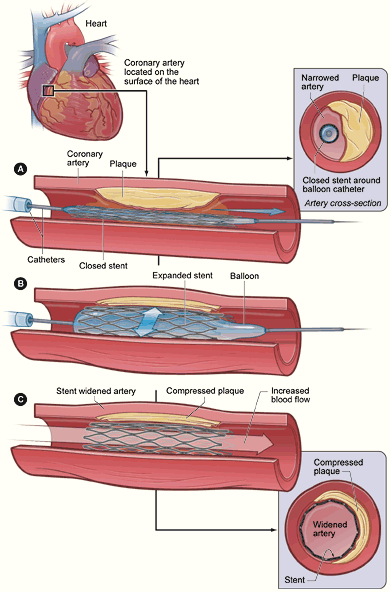 PTCA_stent_NIH_Coronary_Heart_attack_CABG