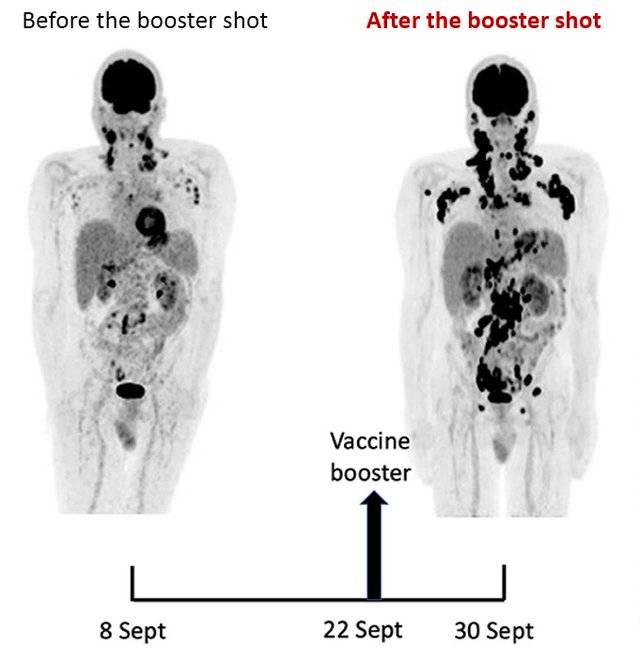 Rapid Progression of Lymphoma After Booster - Jeffrey Dach MD - Booster Shots And Lymphoma Prevention